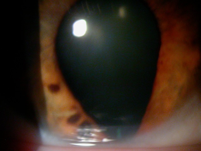 Dyscoria-irregular pupil