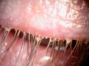 blepharitis