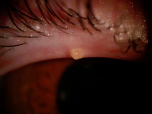 plugged meibomian gland
