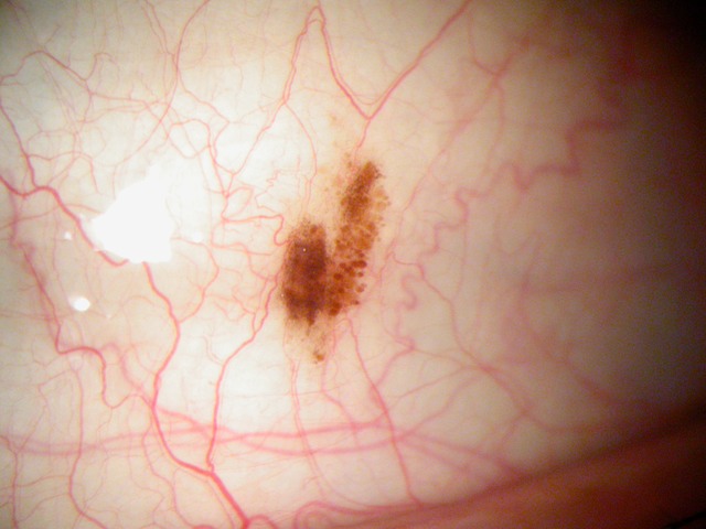 Nevus