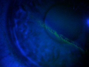 Corneal abrasion