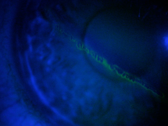Corneal abrasion