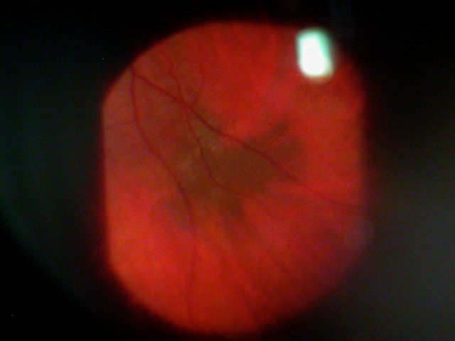 Choroidal nevus