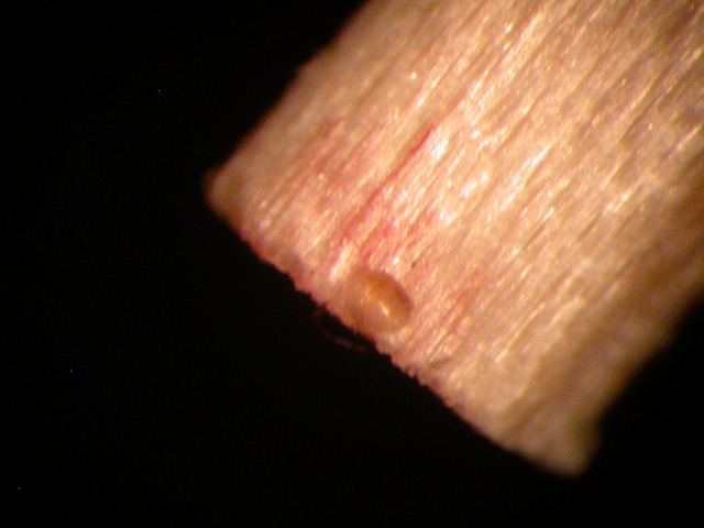 foreign body removed