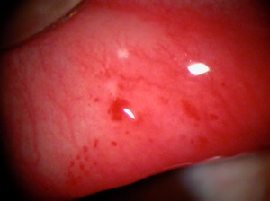 pink eye with hemorrhage