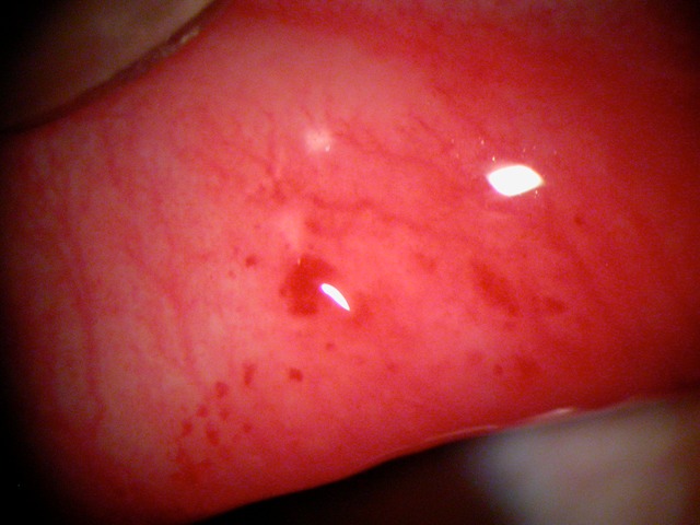 pink eye with hemorrhage